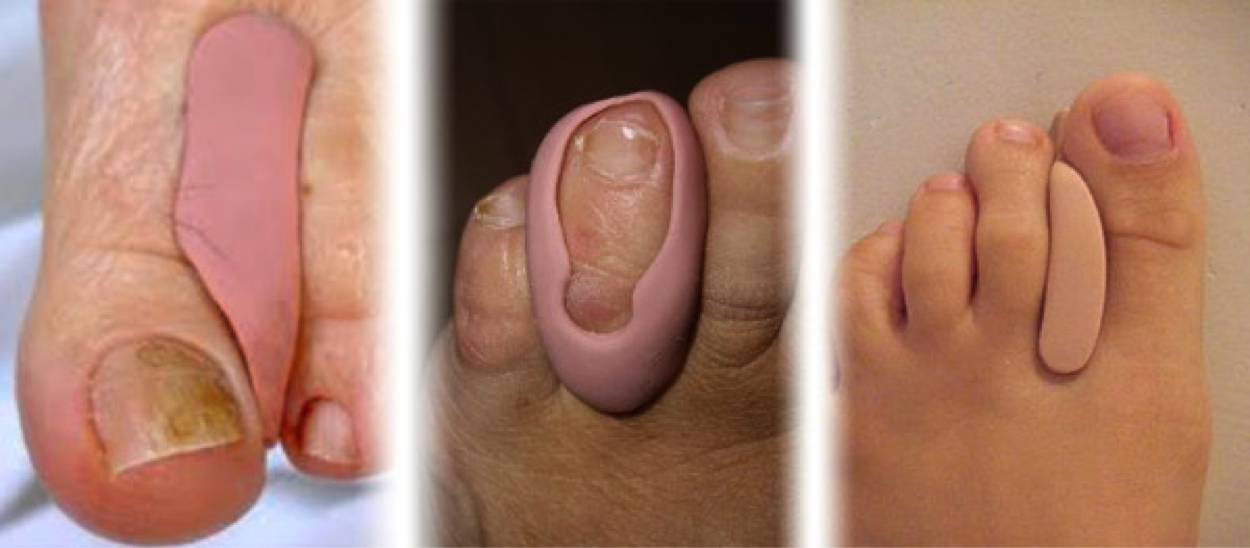 Les dermatoses fréquentes aux pieds/ Frequent dermatoses of the ...